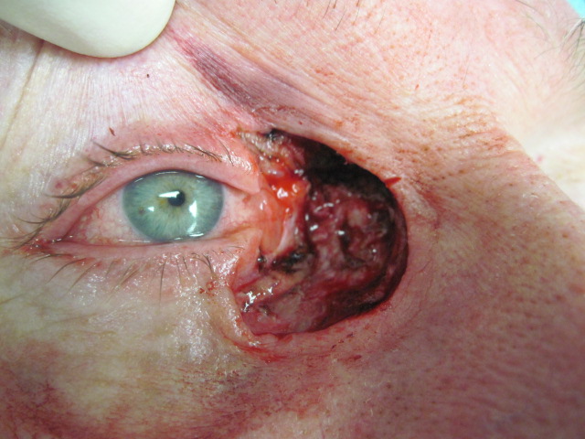 Eyelid lesions - UpToDate